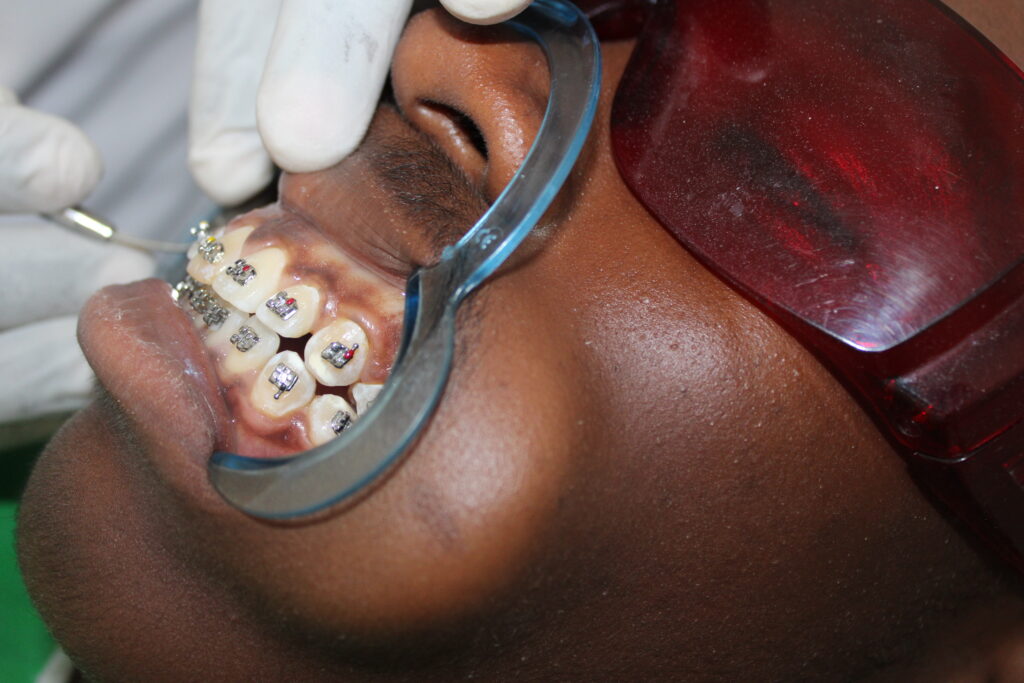 Braces at Affordable prices, Kasarani.